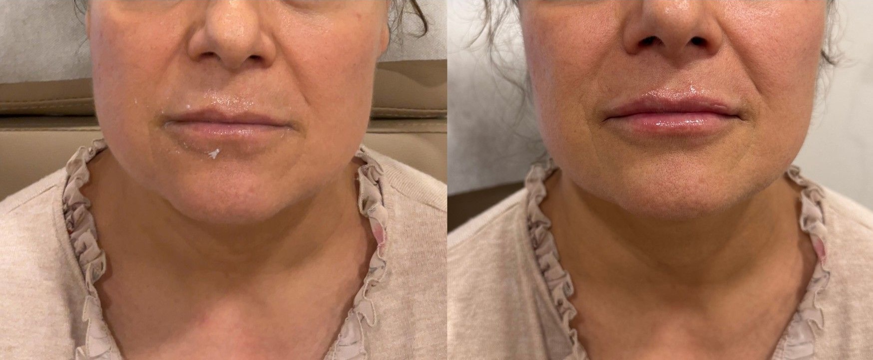 Lip Filler - Before & After